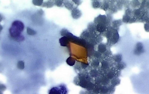 Кристаллы гемосидерина в жидкости Кристаллы гемосидерина в жидкости