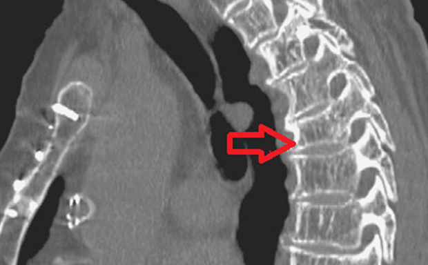 КТ снимок при остеопорозе КТ снимок при остеопорозе
