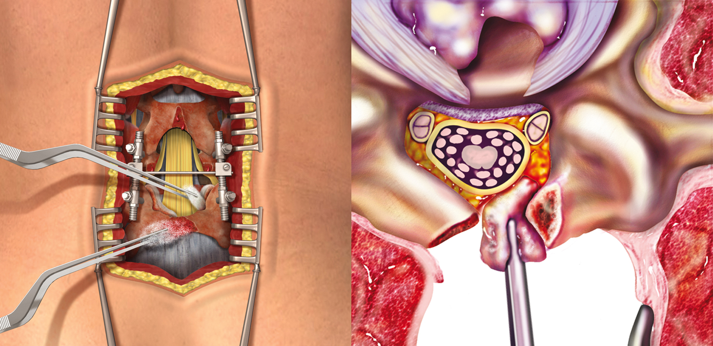 Ламинэктомия Ламинэктомия