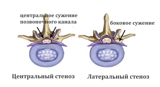 Центральный и латеральный стеноз позвоночного канала Центральный и латеральный стеноз позвоночного канала