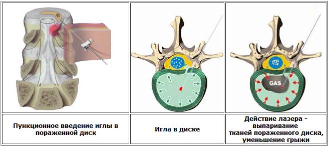 Лазерное лечение межпозвоночной грыжи Лазерное лечение межпозвоночной грыжи
