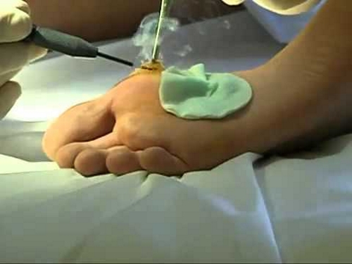 Лечение стоп Сургитроном Лечение стоп Сургитроном