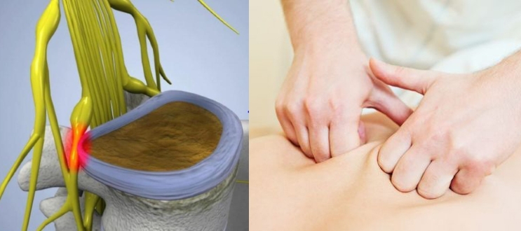 Мануальное лечение защемленного нерва Мануальное лечение защемленного нерва