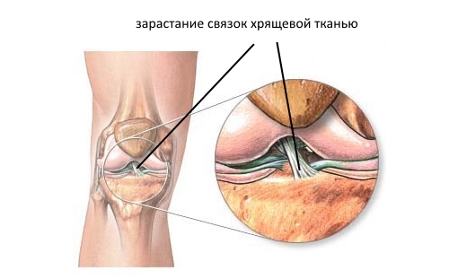 Зарастание связок хрящевой тканью Зарастание связок хрящевой тканью