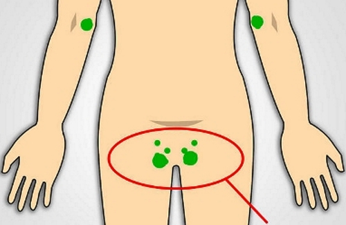 Лимфаденит паха Лимфаденит паха