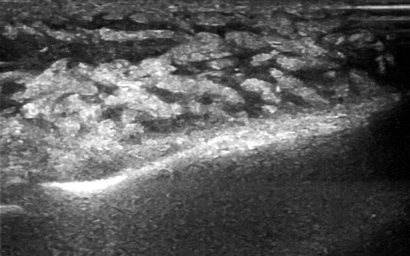 Лимфостаз на УЗИ стопы Лимфостаз на УЗИ стопы