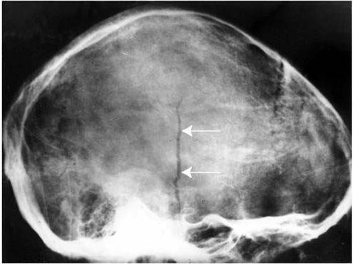 Линейный перелом на МРТ Линейный перелом на МРТ