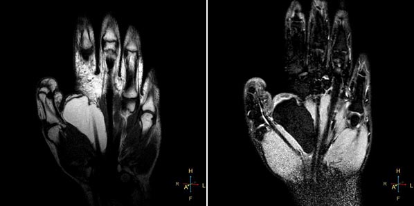 Липома кисти на МРТ Липома кисти на МРТ