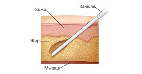 Липосакция Липосакция
