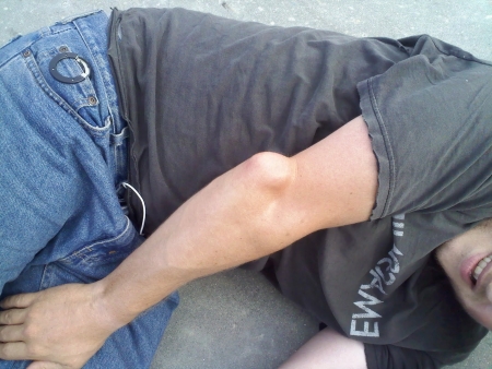 Локоть при вывихе