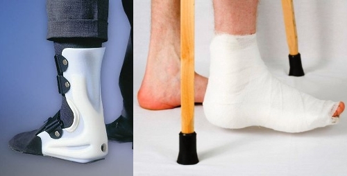 Лонгета и гипс для покоя пятки Лонгета и гипс для покоя пятки
