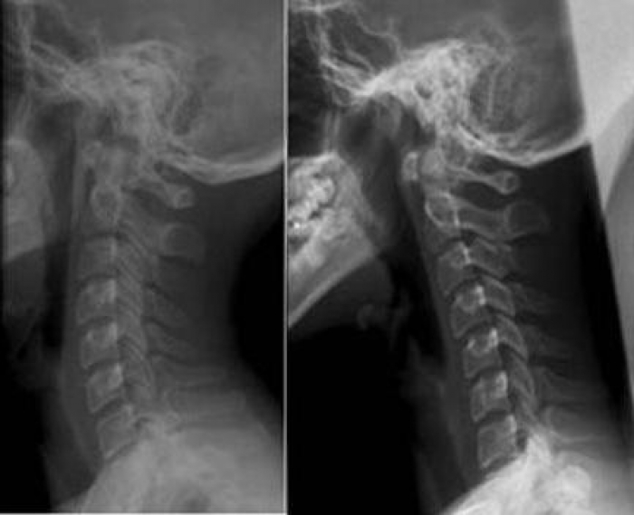 Лордоз на рентген снимке Лордоз на рентген снимке