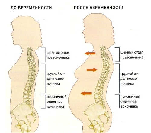 Лордоз при беременности Лордоз при беременности