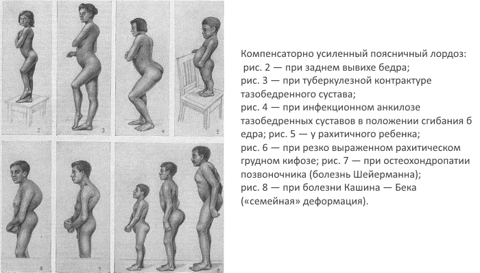 Компенсаторный лордоз Компенсаторный лордоз
