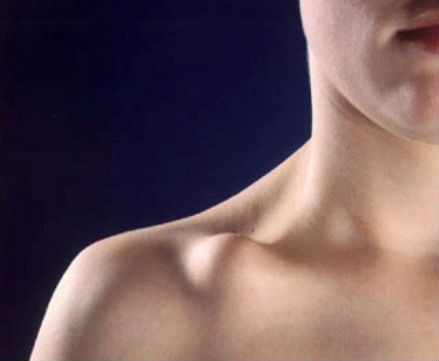 Ложный сустав ключицы