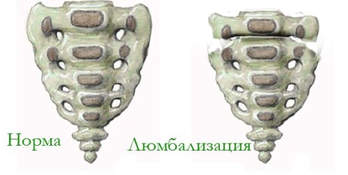 Двусторонняя люмбализация Двусторонняя люмбализация