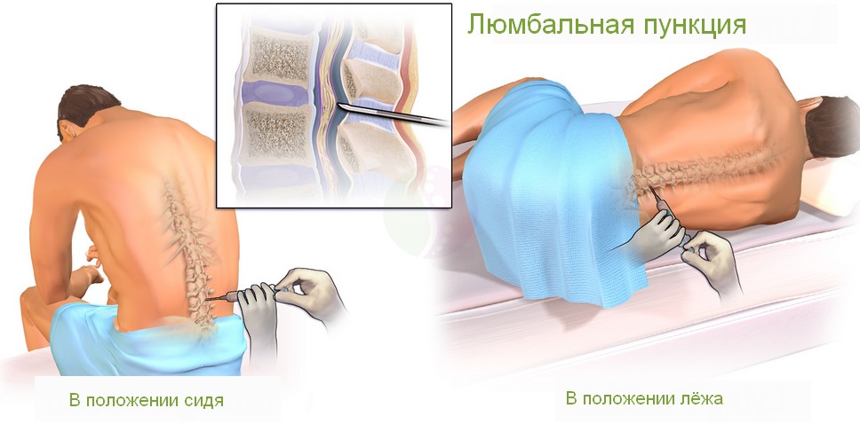 Люмбальная пункция сидя и стоя Люмбальная пункция сидя и стоя