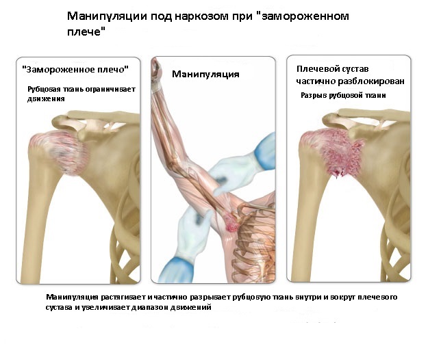 Манипуляции при замороженном плече Манипуляции при замороженном плече