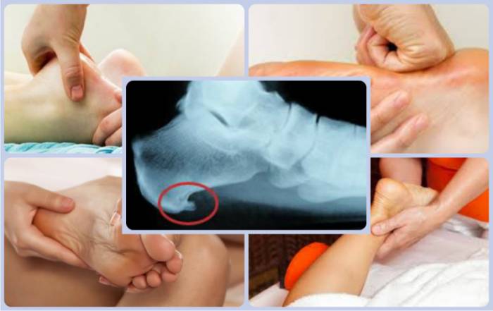 Массаж при пяточной шпоре Массаж при пяточной шпоре