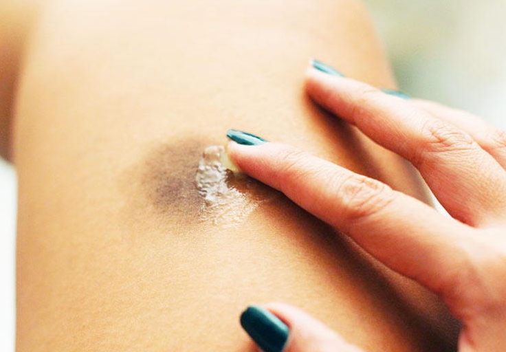 Лечение синяков мазями