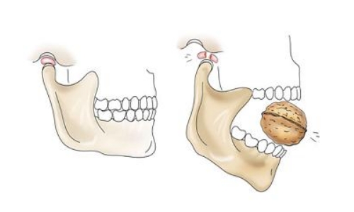 Механическая травма челюстного сустава Механическая травма челюстного сустава