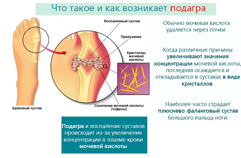 Механизм образования подагры Механизм образования подагры