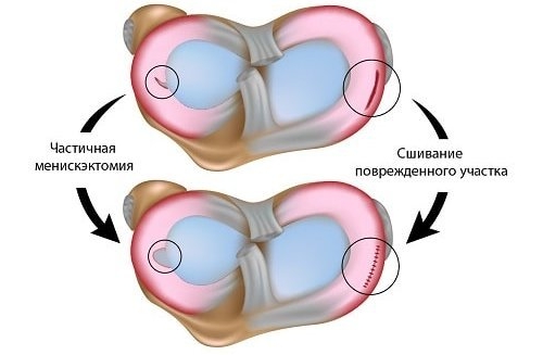 Менискэктомия и сшивание Менискэктомия и сшивание