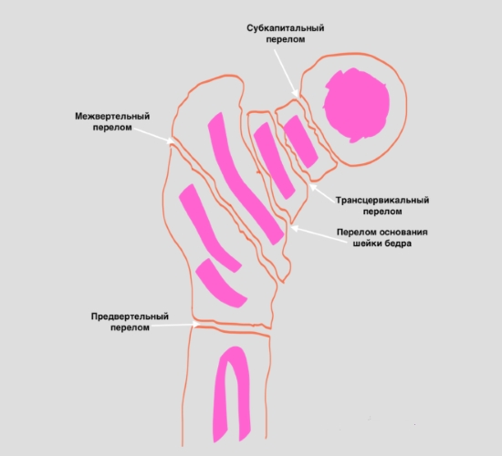 Места переломов шейки бедра Места переломов шейки бедра