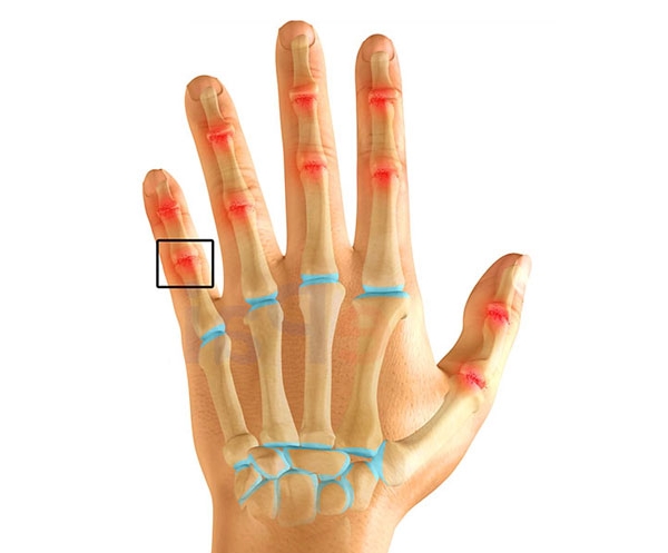 Места воспаления суставной сумки кистей рук Места воспаления суставной сумки кистей рук