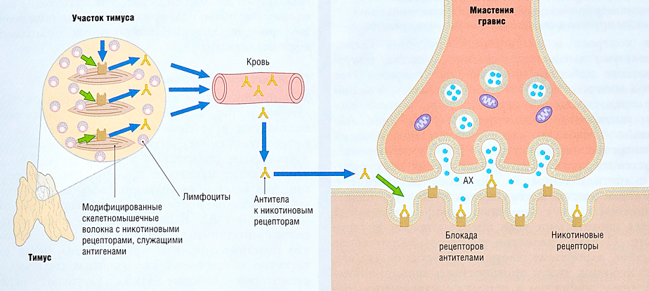 Миастения гравис Миастения гравис