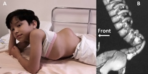 Деформация позвоночника Деформация позвоночника