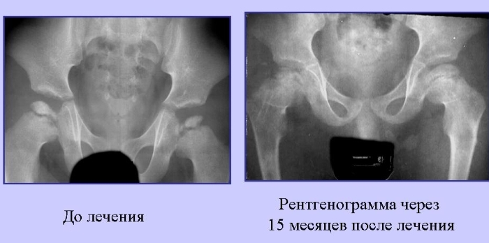 Рентген диагностика миелодисплазии Рентген диагностика миелодисплазии