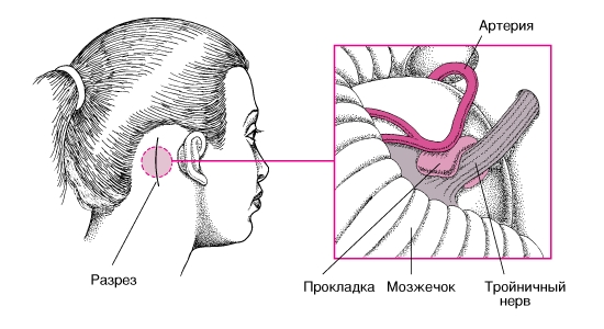 Микроваскулярная декомпрессия Микроваскулярная декомпрессия