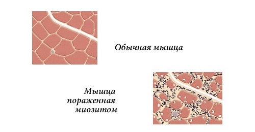 Миозит мышц Миозит мышц