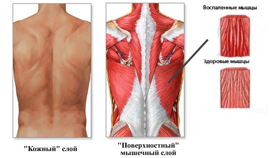 Миозит Миозит