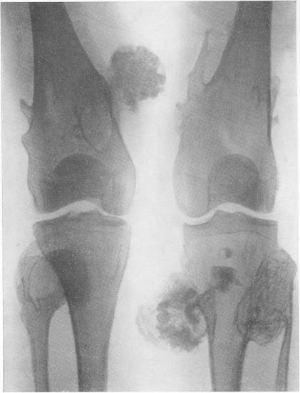 Множественный экзостоз Множественный экзостоз