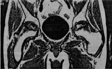 Коксартроз на МРТ снимке Коксартроз на МРТ снимке