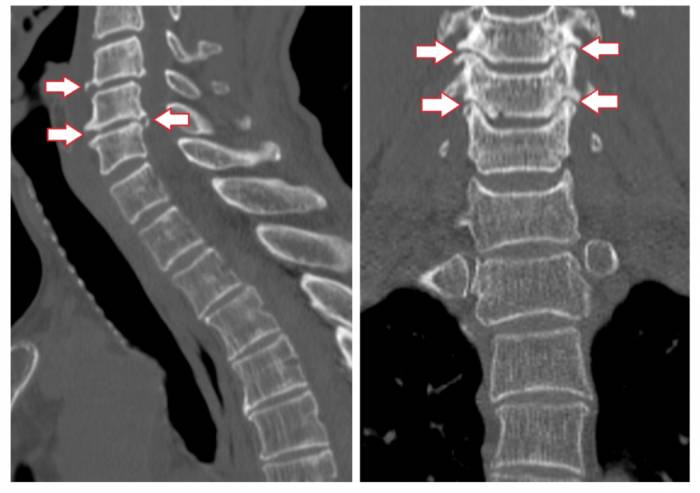 МРТ диагностика шейного артроза МРТ диагностика шейного артроза