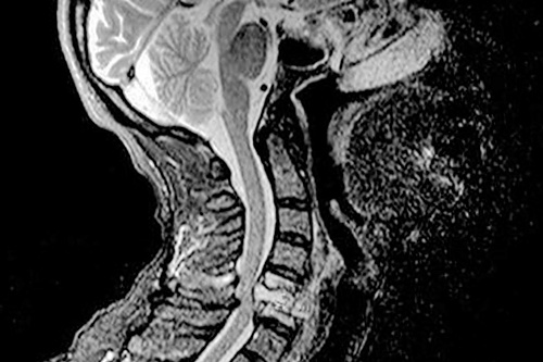 Защемление шейного отдела на МРТ Защемление шейного отдела на МРТ