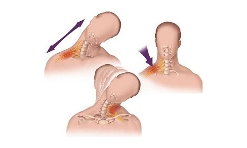 Мышечный спазм и боль при плечевом неврите Мышечный спазм и боль при плечевом неврите