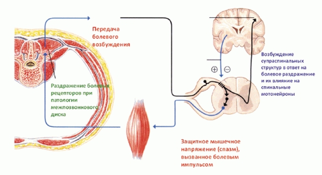 Мышечный спазм Мышечный спазм
