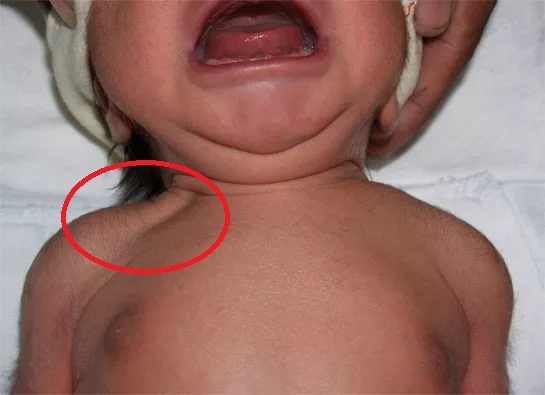 Надключичная ямка Надключичная ямка