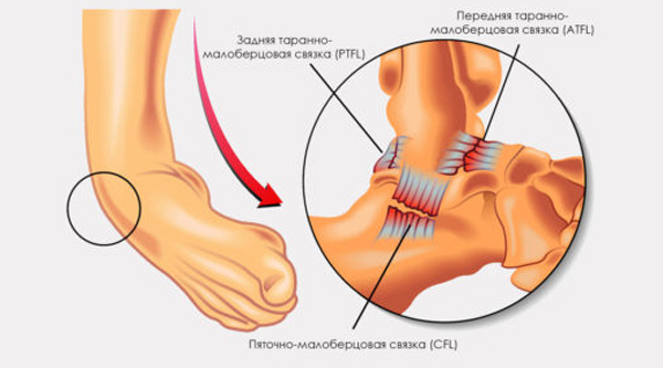 Виды разрыва связок голеностопа Виды разрыва связок голеностопа