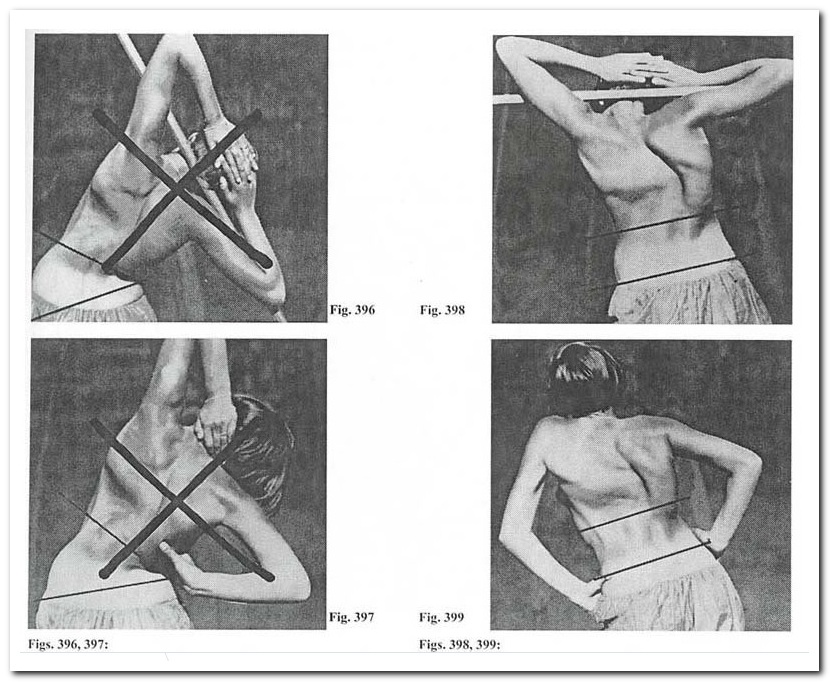 Наклоны при сколиозе Наклоны при сколиозе