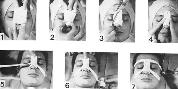 Наложение гипсовой повязки на нос Наложение гипсовой повязки на нос