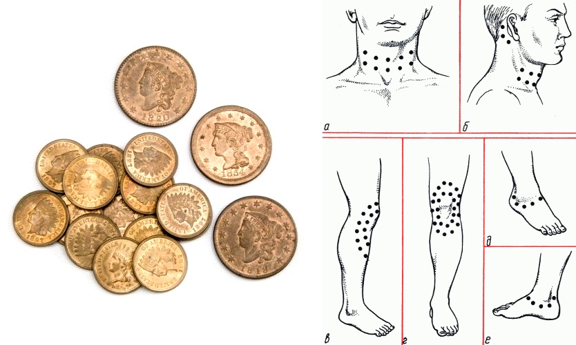 Наложение медных монет на суставы Наложение медных монет на суставы