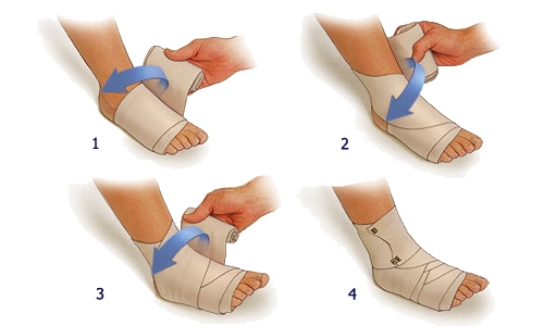 Наложение тугой повязки на голеностоп Наложение тугой повязки на голеностоп