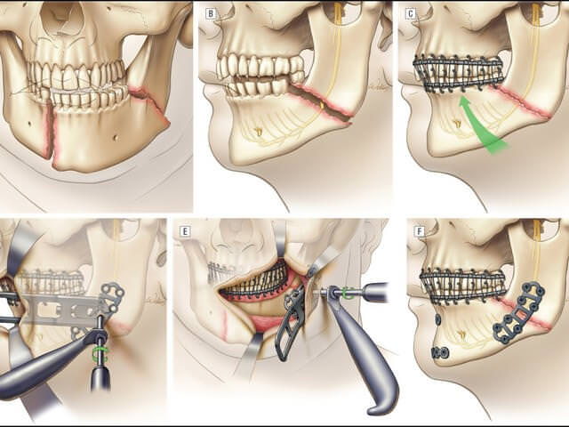 Наложение проволочной шины при переломе челюсти Наложение проволочной шины при переломе челюсти