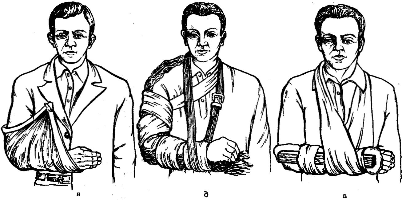 Наложение шин при переломе Наложение шин при переломе