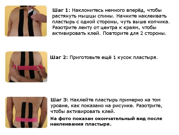 Наложение тейпов при грыже позвоночника Наложение тейпов при грыже позвоночника